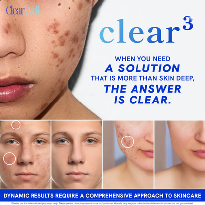 ClearWell™ Acne Skin Support